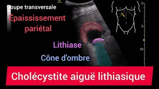 Cholécystite Aiguë Lithiasique Échographie [upl. by Combs]