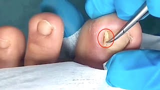 【Daily Pedicure Tutorial】Digging Out The Ingrown Nail And Then Stuffing Cotton To Stop The Bleeding [upl. by Suollecram]