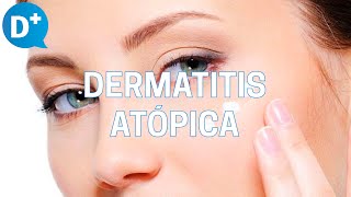 Diagnóstico y tratamiento de la dermatitis atópica [upl. by Annahahs]