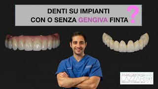 Denti su impianti con o senza gengiva finta [upl. by Quill]