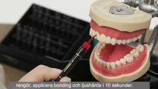 Uveneer Creating Temporary Veneers Swedish [upl. by Ecinahs250]