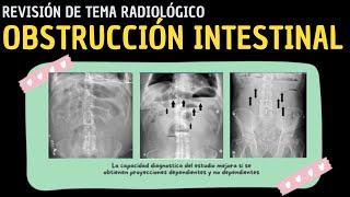 Revisión de Tema 84 Obstrucción intestinal [upl. by Akimed]