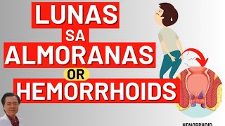 Lunas sa Almoranas or Hemorrhoids  By Doc Willie Ong [upl. by Ahsitruc]