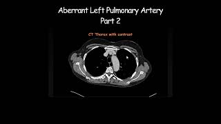 Aberrant Left Pulmonary Artery Part 2 radiology radiologist anatomy [upl. by Naitsirt]