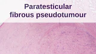 Paratesticular Fibrous Pseudotumour  Pathology mini tutorial [upl. by Margret]