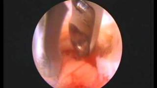 Video Beeld endoscopische hernia operatie [upl. by Badr769]