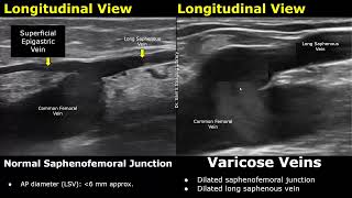 Saphenous Vein Doppler Ultrasound Normal Vs Abnormal  Varicose Veins  Lower Limb Vascular USG [upl. by Amby]