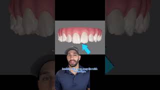 Invisalign treatment to straighten overlapped and crooked front teeth [upl. by Darleen]