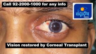 Corneal transplant result DALK [upl. by Mairhpe]