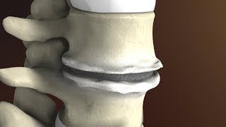 Degenerative Disc Disease Spondylosis explained by Spine Surgeon Dr Jessica Shellock Plano TX [upl. by Annat]