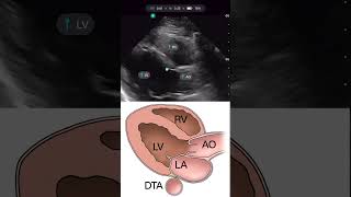 Parasternal Long Axis with Handheld Ultrasound Exo Iris® [upl. by Nirehs]