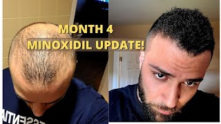 Month 4 ROGAINE RESULTS Minoxidil  Safflower oil [upl. by Etnomaj]