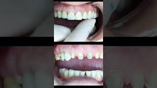 Anterior teeth Restoration  Zirconium Crown shorts dentist [upl. by Richarda]