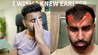 How To Know If Youre Going Bald  Early Male Pattern Baldness Signs [upl. by Norit580]