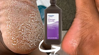 TRY HYDROGEN PEROXIDE ON YOUR FEET AND SEE WHAT HAPPENS Shocking [upl. by Tidwell42]