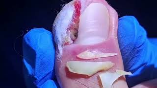 Removing Severely Infected Ingrown Toenails Patient Feels Relief After the Surgery [upl. by Medlin]