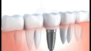 implant tedavisinin detaylı aşamaları 2 diş için [upl. by Ardnuek420]