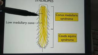 Cauda Equina Syndrome [upl. by Roban]