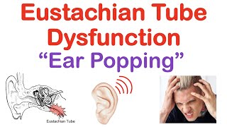 Eustachian Tube Dysfunction “Popping Sound in Ears”  Causes Symptoms Diagnosis Treatment [upl. by Darwin]