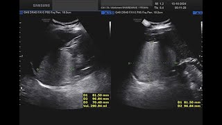 angiomiolipoma surrenalico destro [upl. by Otnas]