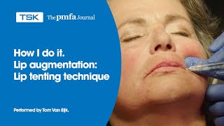 Lip augmentation Lip Tenting Technique by Tom van Eijk [upl. by Caryn]