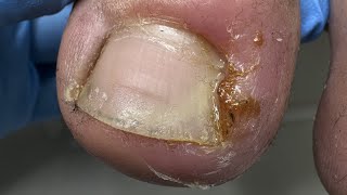 Ingrown toenail removal Medical procedure [upl. by Uel640]