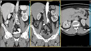 The Importance of MRI in Imaging Renal Masses [upl. by Parthen569]