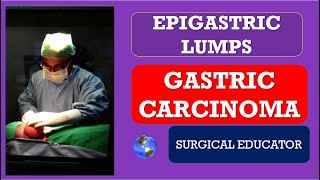 GASTRIC CARCINOMA How to DIAGNOSE amp TREAT EPIGASTRIC LUMPS Abdominal Lumps [upl. by Lewison932]