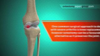 Osteotomy Animation i [upl. by Belayneh]