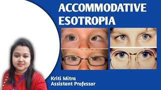 ACCOMMODATIVE ESOTROPIA [upl. by Ronnie]