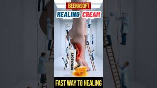 Heal Diabetic Foot Ulcers Fast with BeenaSoft Cream  Best Treatment for Bedsores shorts [upl. by Quartis934]