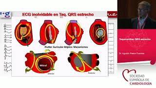 Los electrocardiogramas que no puedes olvidar [upl. by Oisacin]