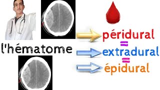 lhématome péridural extradural épidural [upl. by Zelle998]