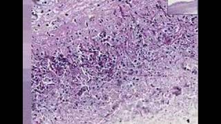 Histopathology Colon esophagus Candidiasis [upl. by Keraj]