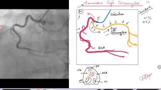 Coronary Angiogram Anomalous Left Circumflex Coronary Artery [upl. by Doi]