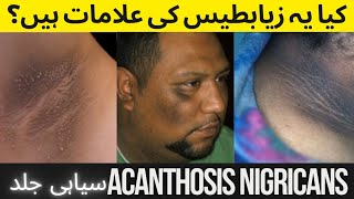 Acanthosis Nigricans Causes  Symptoms Treatment [upl. by Hessney]