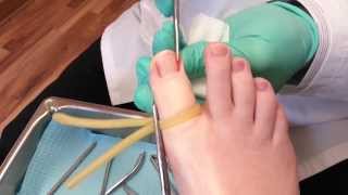 Ingrown toenail surgery [upl. by Ebenezer375]