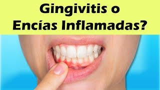 COMO CURAR LA GINGIVITIS Remedios Caseros Para La Gingivitis y Encías Inflamadas [upl. by Ulrikaumeko]