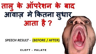 तालु के ऑपरेशन के बाद आवाज़ मे कितना सुधार होता है  Speech After Cleft Palate Surgery  Nuface [upl. by Maible]