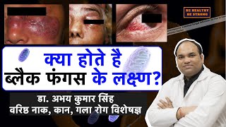 Coronavirus MucormycosisBlack Fungus Symptoms in Hindi Dr Abhay Kumar Singh SrENT Consultant [upl. by Schram]