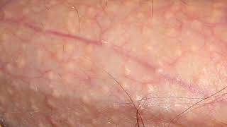 Learn about fordyce spots  what is adnexa [upl. by Theall]