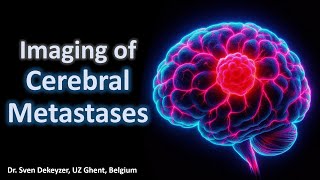 Imaging of cerebral metastases [upl. by Sokim]