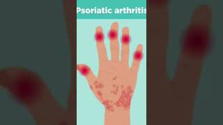 Psoriatic arthritis rheumatology psoriasis ytshort ytytshorts [upl. by Kari]