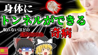 【2004年】皮膚にトンネルができる奇病？我慢できないquot地獄のかゆみquot検査でも中々わからない意外な原因『疥癬 ヒゼンダニ感染症』 【ゆっくり解説】 [upl. by Doggett]