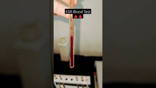 Erythrocyte Sedimentation Rate  ESR  What does the ESR test show What does high ESR mean [upl. by Tterraj]