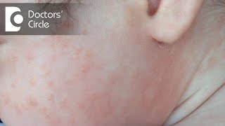 What are the causes of Rashes  Dr Rashmi Ravindra [upl. by Abehsat]