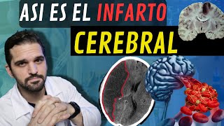 ATENCIÓN¡ Síntomas y causas de los INFARTOS CEREBRALES 💥🧠 [upl. by Ytsim]