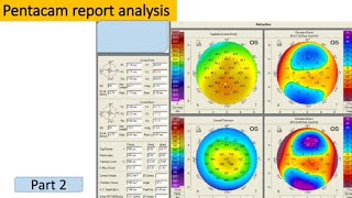 Pentacam report analysis [upl. by Natalina]