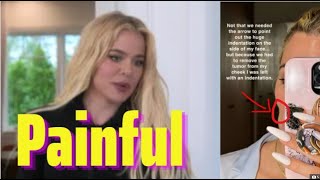 Khloe Kardashian revealed her disfigured face with extremely scary injuries [upl. by Sibie]