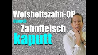 WeisheitszahnOP Zahnfleisch hängt jetzt FALSCH am ZAHN [upl. by Heidt]